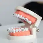 Model of dental braces on a dental mold, illustrating orthodontic treatment options related to cosmetic dentistry.