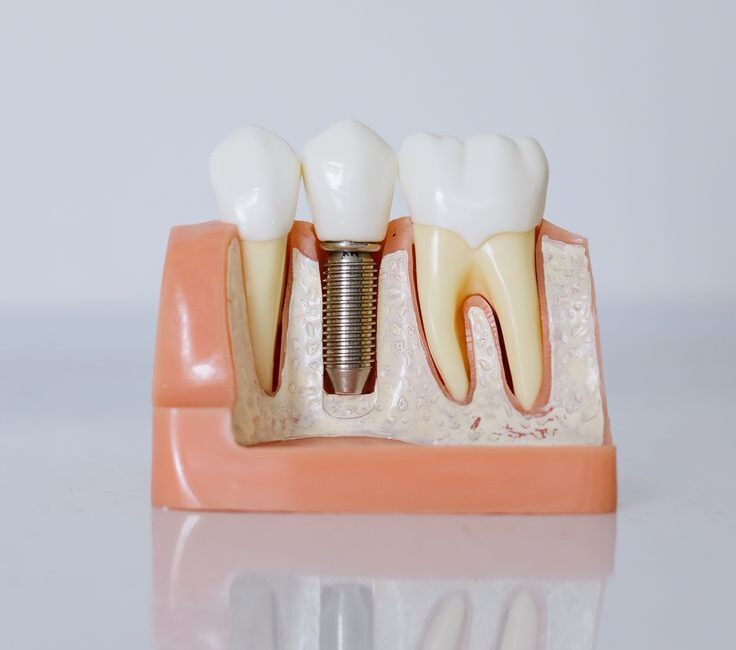 Model of dental implants and teeth