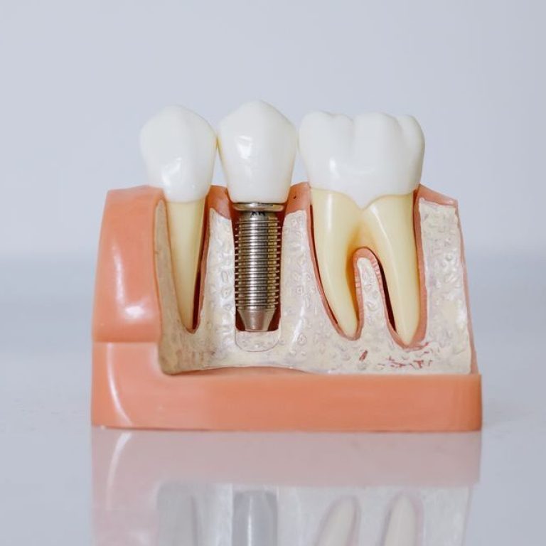 Model of dental implants and teeth